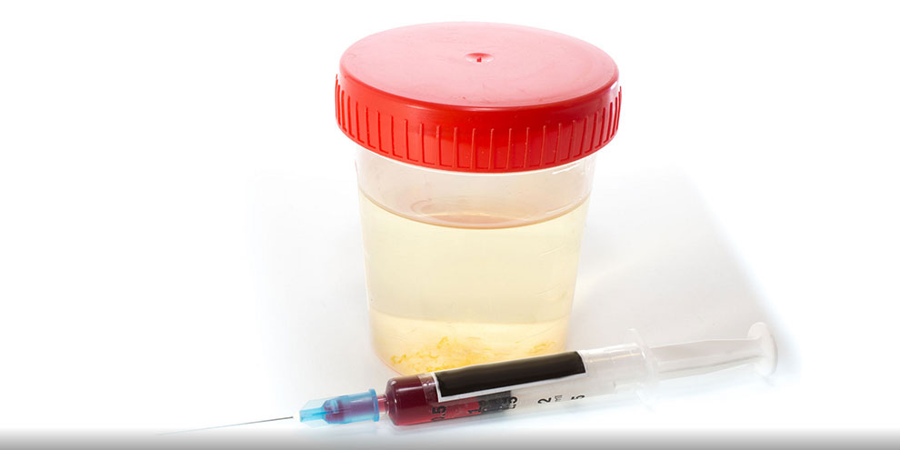 В Свердловской области открываются пункты быстрого тестирования на ВИЧ